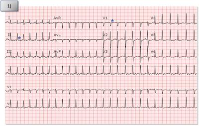 Case report: A case of perinodal atrial tachycardia and review of the relevant clinical anatomy surrounding the retroaortic node